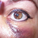 48 hours. I continued warm compresses and light to moderate massage to disperse the overfill or swollen fluid.