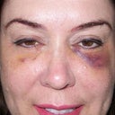 72 hrs after Artefill.  Massaging is helping to make each eye symmetrical.  Bruising is still there.