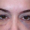 4th day.  Makeup and concealer only minimally covers this dark bruising. I am happy with the symmetry.  I read on Real Self this might take 10 days for bruising to disappear.  As long as it looks even I will be okay.