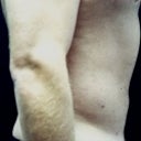 Liposuction