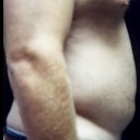 Liposuction