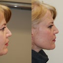 Bridge has much added volume for a more smooth profile