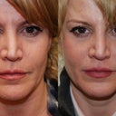 The pinched appearance  and the over reduction has been softened quite a bit, I will need another treatment to attain my goal of a more symmetrical nose - but I am on my way!