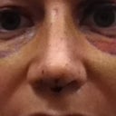 After splint removal at 7 days