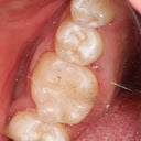Replacement Of Silver Amalgam Fillings With Tooth-Colored Composite Fillings