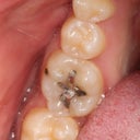 Replacement Of Silver Amalgam Fillings With Tooth-Colored Composite Fillings