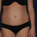 pre-op front