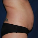 preop side