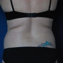 preop back