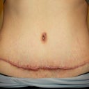 close up of scar at 6 months, again the day after steroid shots