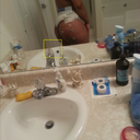side view 3 days post op