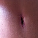 11 weeks post op