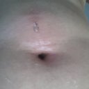 Front view of boil that I squeezed on Day 15. There was blood initially then yellowish pus that came out. The area is swollen n hard. Worried.