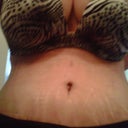 new stretch mark above new belly button