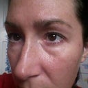 Hideous bags and drooping cheek (33 weeks)