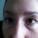 swollen, painful upper lids. Eyes are completely hooded and lid is not visible. Feels heavy and uncomfortable 24/7.