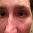 Week 32 - eyes suddenly became "sunken" - lid visible, HUGE eyebrow muscles, eyes look poked into head. Swelling returned 2 days later with a vengence and has progressively worsened for 3 weeks.