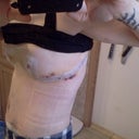 my incision extends all the way to my back to take up the extra skin I had there from weightloss