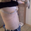 my incision extends all the way to my back to take up the extra skin I had there from weightloss