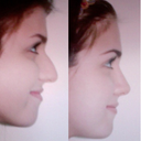 Actual before and afters taken by Dr.C! 3 months later!