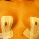 14 Days Post-Op - Front View