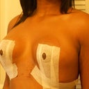 14 Days Post-Op - Adjusted Left Angle