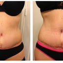 This is my swelling from working out :(  Check out how straight my mid line incision was getting.  You can really see how the swelling pulls the crap out of it.