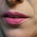 2 weeks before Sculptra
