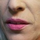 2 weeks before Sculptra