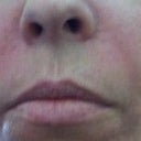 Night after Sculptra Injections