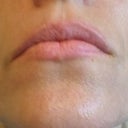 Laugh lines after 30 days post 1 Treatment