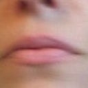 Laugh lines after 30 days post 1 Treatment