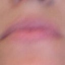 Laugh lines after 30 days post 1 Treatment