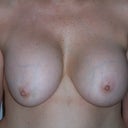 front preop 8/25/2012