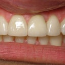 Implant Crown, Bonding & Veneer Before & After Photo