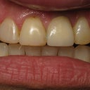 Implant Crown, Bonding & Veneer Before & After Photo