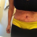 Bending forward.   Before there was this Jabba the Hutt looking deal (see Pre-Op Pic)