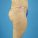 Right side 6 wks