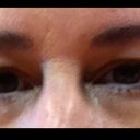 My eyelids PreOp.
