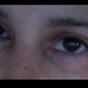 Eyelids PostOp 3 weeks. You can see the redness of the chemical peel under my eyes.  My PS said it will take about 6 weeks for the redness to subside.