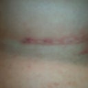 Incision 6 weeks