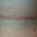 Incision 6 weeks