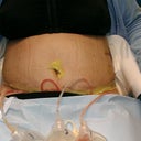 Post Op Day 4 Very swollen and Lipo stitches removed. Wrinkles from the binder NOT stretch marks.