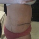 Post op day 9
