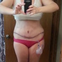Post op day 12