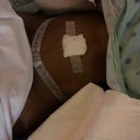After surgery
