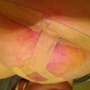 Underneath left side day 9 post op - increased swelling and just developed this redness today.