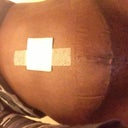12d po keep my bob covered. It's dry I guess he will take suture out tomorrow at po appt