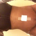 12d po a lot of hard swelling at lower abd