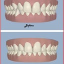 Clincheck Before and After
